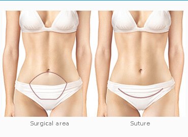 Abdominoplastie femei